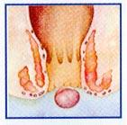 thrombosed-hemorrhoid